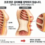 코르셋 흉곽 축소, 의학적 효과와 부작용의 진실