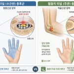 손 저림 원인인 정중신경과 척골신경의 감각 지배 영역 비교