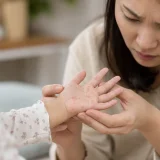 수족구병 발진이 생긴 아이의 손