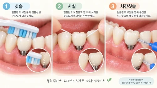 임플란트 보철물 주변 칫솔 치실 치간칫솔 관리