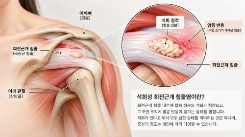 어깨 관절과 회전근개 힘줄을 단순화한 의료 인포그래픽.