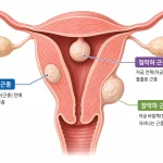 자궁근종의 종류를 보여주는 자궁 단면도