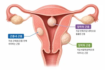 자궁근종 치료, 꼭 수술해야 할까? 위치와 증상에 따른 치료법 정리