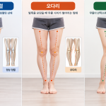 휜다리교정, 정상적인 하지 정렬과 오다리, 엑스다리의 차이를 한눈에 비교할 수 있는 전문 의료 인포그래픽