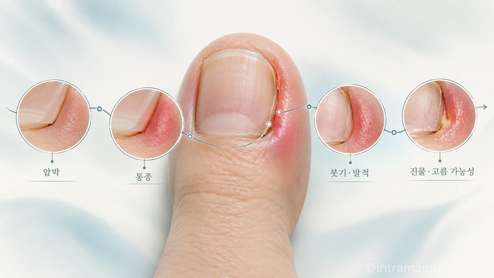 내성발톱 치료는 통증·염증·재발·발톱모양을 함께 살펴보고 현재 상태에 따라 보존적 관리와 교정, 시술 여부를 판단하는 것이 중요하다. (사진=생성형AI)